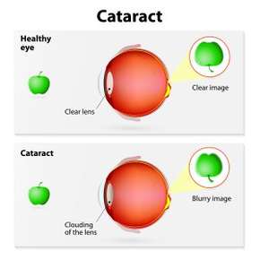 chart displaying what cataract is